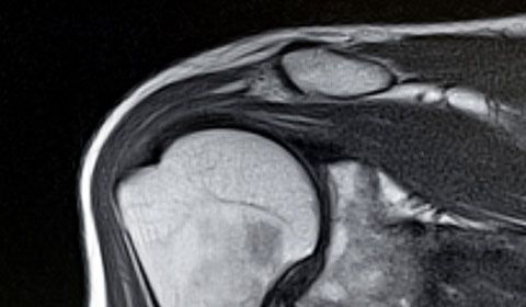 shoulder mri scan