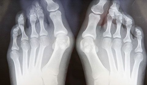 xray of feet with bunions