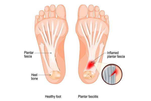 Stretches for Heel Pain by Sydney Heel Pain Clinic
