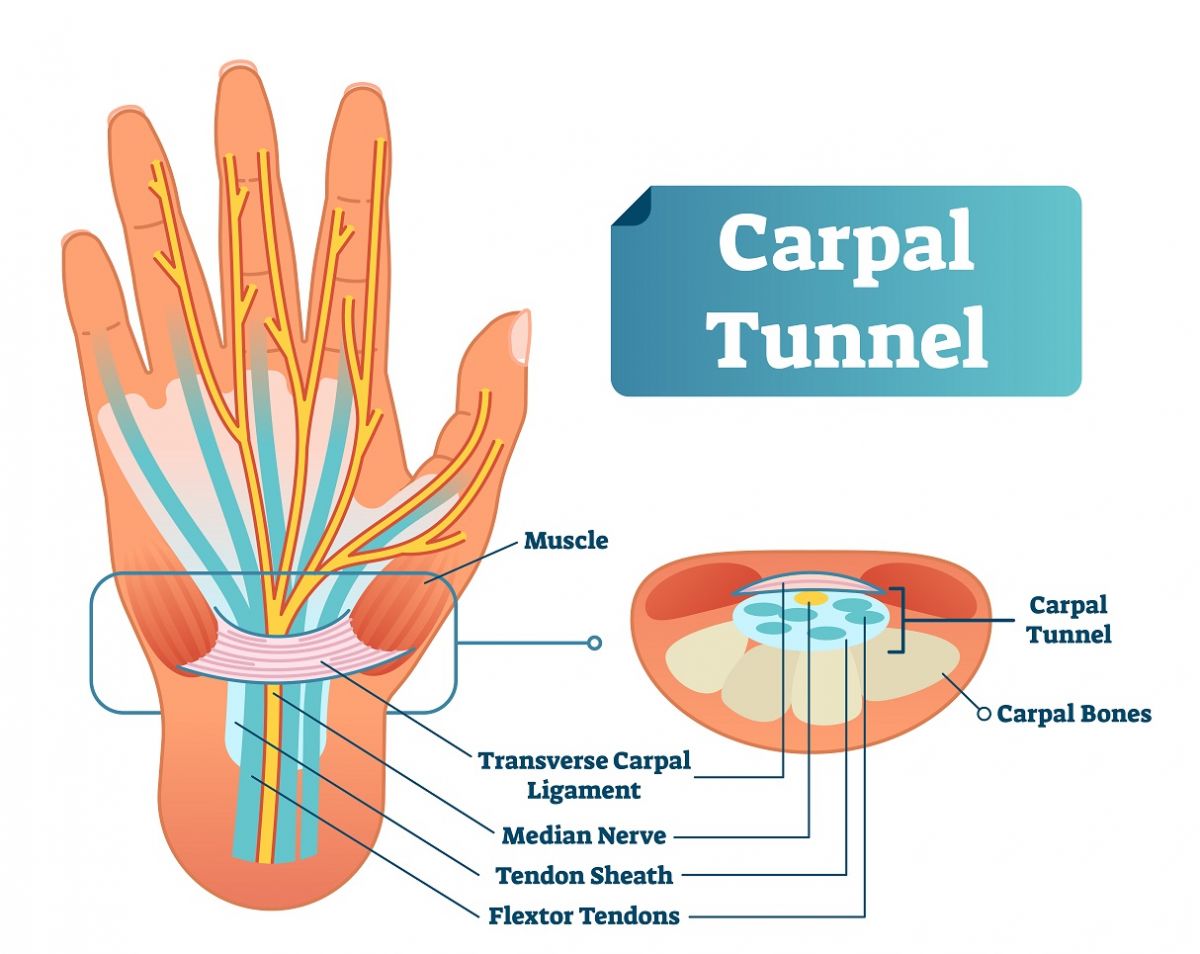 Carpal tunnel syndrome - hetyplant