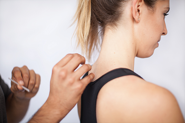 second woman getting acupuncture