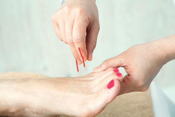 Foot getting acupuncture