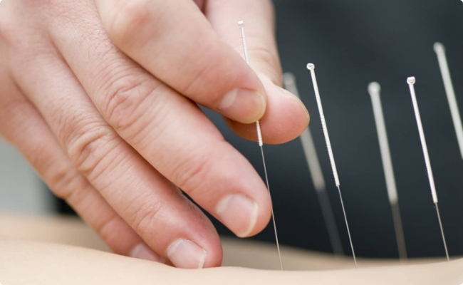 Acupuncture