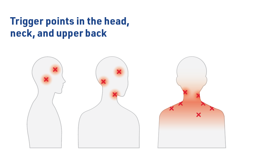 Trigger points in head, neck, and upper back