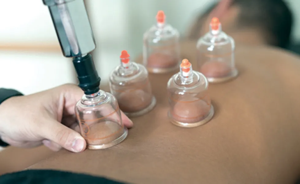 Cupping